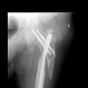 Hardware failure, dislocation, PFN, proximal femoral nail, calcification in gluteus muscle after injection: X-ray - Plain radiograph